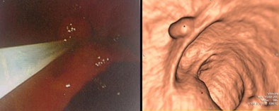 2008 06 23 13 59 51 73 Burling 8mmpolyp Ac