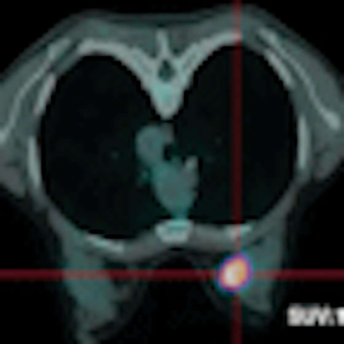 Dual-time-point FDG-PET/CT improves breast imaging accuracy ...