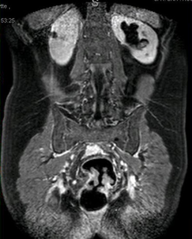 2009 01 15 16 54 01 303 Achiam obstructumor