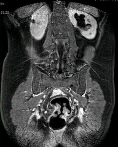 2009 01 15 16 54 01 303 Achiam obstructumor