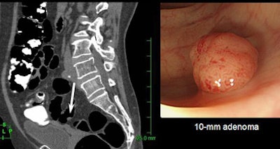 2009 03 07 12 00 15 770 Nappi 10mmadenoma