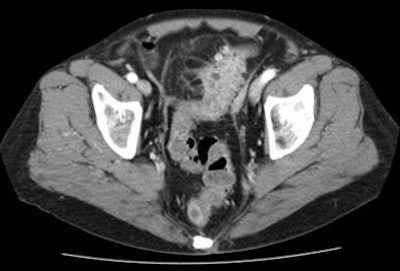 2009 09 22 12 27 27 223 Rogalla intramuralabscess bottom