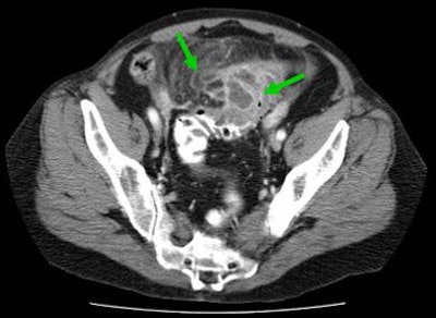 2009 09 22 12 27 32 510 Rogalla intramural abscess top