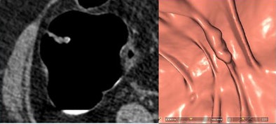 2009 12 15 13 33 34 968 Iafrate 6lesions bottom