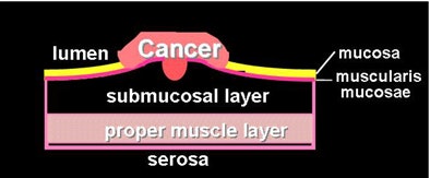 2010 02 03 15 42 52 904 Slabaugh ccsi lesion