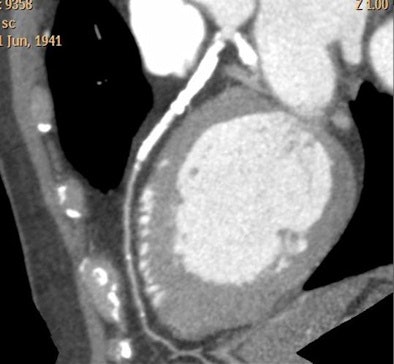 2010 02 19 17 29 50 316 Bovenschulte calcification