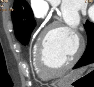 2010 02 19 17 29 50 316 Bovenschulte calcification