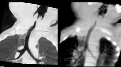 2010 02 24 17 08 09 40 Rogalla hemangioma top