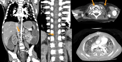 2010 02 24 17 08 14 968 Rogalla hemangioma bottom