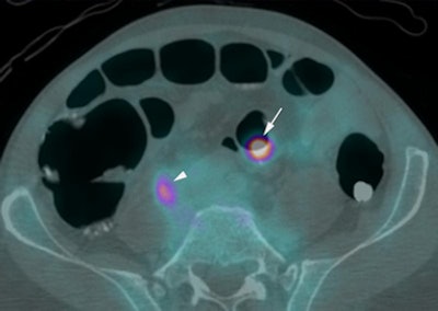 2010 05 26 11 12 18 921 Taylor pet ct bottom 394