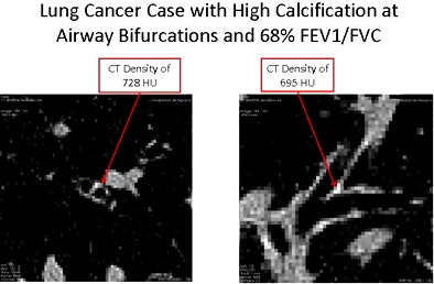 2010 06 25 15 08 07 539 Avila lungcancer