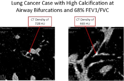 2010 06 25 15 08 07 539 Avila lungcancer