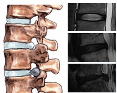 2010 06 25 15 43 16 217 Michopoulu herniation