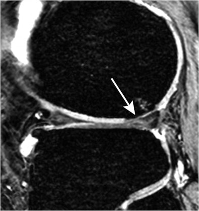2010 06 30 10 01 10 910 Huetink Mri Osteo 394