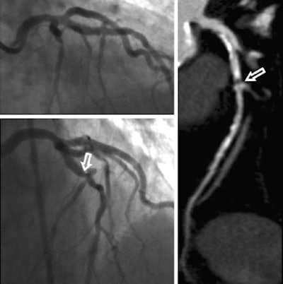 Invasive coronary angiography and coronary CTA studies in a 62-year-old woman. Significant stenosis of the mid left anterior descending coronary artery (arrows) just proximal to the second diagonal branch was missed during initial interpretation of invasive coronary angiograms (upper left) due to superimposition of vessels. The lesion was detected on coronary CTA, displayed as curved multiplanar reformat (right). Re-evaluation of invasive coronary angiography (lower left) after unblinding of coronary CTA results confirms lesion in a single angiographic projection. Images courtesy of Matt Kerl, MD, and U. Joseph Schoepf, MD.