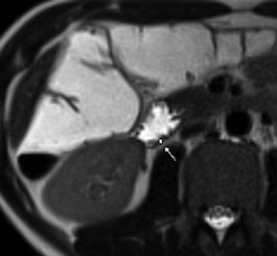 2010 08 31 13 38 55 49 Celiac Treated B 250