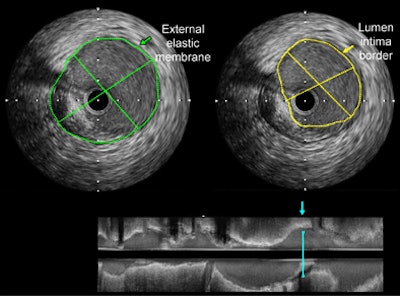 2010 09 20 13 10 41 877 Dey athero
