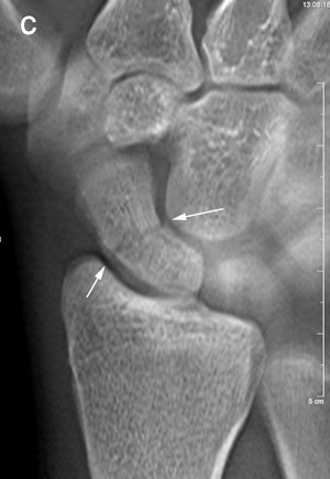 Same patient above. With tomosynthesis (c), a nondisplaced scaphoid wrist fracture was observed in the dorsal cortex (arrows).