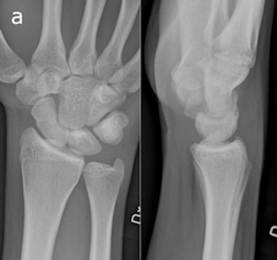 A 20-year-old man who had initial negative wrist and scaphoid radiographs. The follow-up radiograph (a) was normal. No fractures were observed in enlargements of the wrist radiographs and two scaphoid views (b). All images reprinted with permission of Springer Publishing.