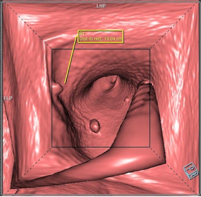 2011 02 10 16 01 34 366 Syngo Via Colon 394