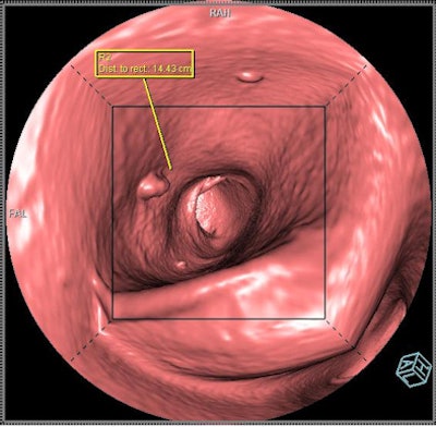 2011 02 10 16 01 39 869 Syngo Via Colon 3 394