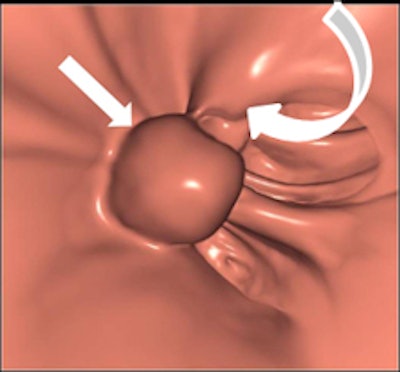 Left: Coronal reformatted view showing a pedunculated polyp of the sigmoid colon. Right: Volume-rendered endoluminal view of the same pedunculated polyp. In both images, the curved arrow indicates the stalk, and the straight arrow indicates the head of the polyp. Images courtesy of Andrea Laghi, MD.