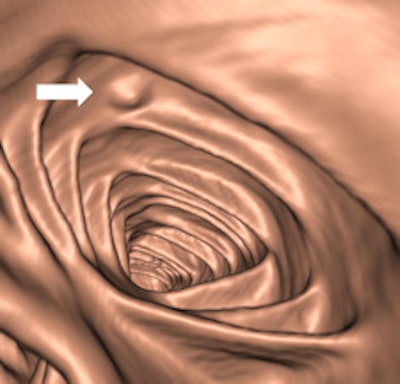 Left: Small 7-mm polyp in colon, drowned in tagged fluid in supine position (white arrow). Right: Corresponding 3D view in prone position shows the same polyp (white arrow). Images courtesy of Philippe Lefere, MD.