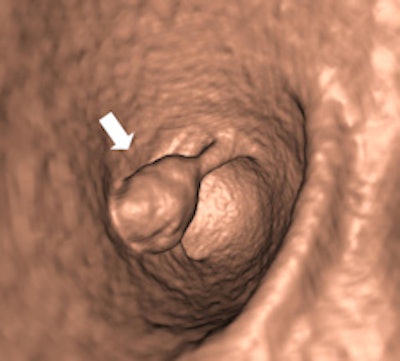 Left: Large pedunculated polyp in the sigmoid (white arrow). Right: Corresponding 3D image of this pedunculated polyp with a 2-cm head (white arrow). Images courtesy of Philippe Lefere, MD.