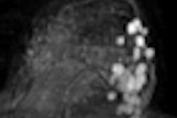 2011 02 28 15 41 43 378 2011 03 04 Breast Mri Thumb2