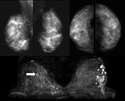 A 36-year-old woman with palpable nodules at the lower external left quadrant. Mammography (upper panels) shows an extremely dense pattern without any suspicious finding on either right or left breast. Ultrasound (not shown) demonstrated three hypoechoic nodules. One of them was biopsied, revealing invasive ductal cancer. MRI (lower panel) showed 22 suspicious enhancing lesions confined in the lower external quadrant of the left breast. Moreover, one enhancing lesion is found in the right breast (arrow), undetectable at targeted second-look ultrasound. The patient refused MR-guided biopsy of the contralateral lesion. Left mastectomy was performed, confirming multifocal cancer on the left. At one-year MRI follow-up after chemotherapy, the contralateral lesion was no longer detectable. Images courtesy of Dr. Francesco Sardanelli.