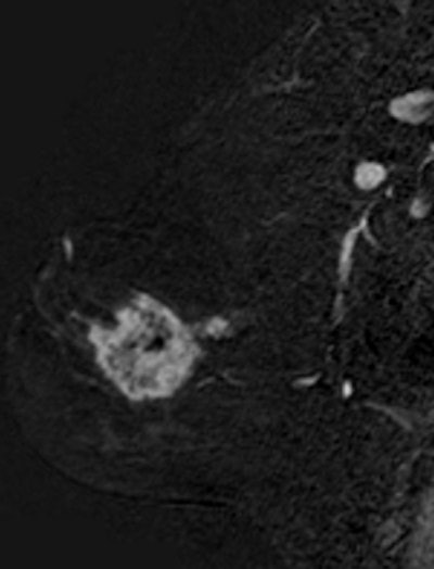 Breast cancer staging in a 42-year-old woman using sagittal 3D sequence with gadolinium chelates injection, subtraction. A bifocal lesion is seen on this view. The size of the largest lesion was 50 mm. Mammography and ultrasound only depicted a unique 40-mm lesion. Breast MRI can be a valuable imaging tool for staging lobular infiltrative carcinoma, as in this case. Image courtesy of Dr. Corinne Balleyguier.