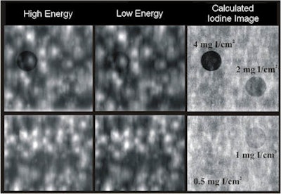 This is a dual-energy image of an iodine phantom. The left image was taken with high energy. The middle image was taken with low energy. The right-hand image is the resulting image that shows the iodine disks much more clearly than the other two. The background structure is also greatly reduced. Image courtesy of Christer Ullberg.