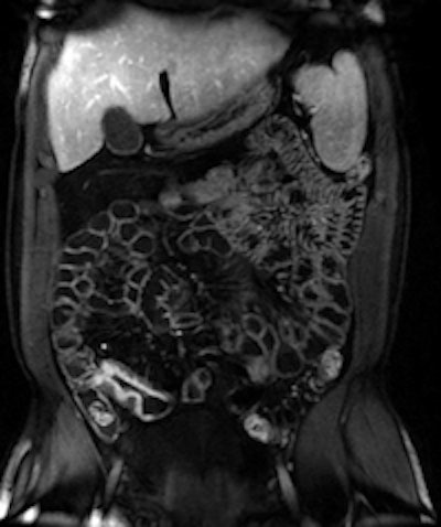 Acute ileal involvement by Crohn's disease, with wall thickening and mucosal enhancement.