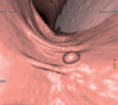 ColoVirt 2D and 3D show the same image of a small (7 mm) sessile polyp of the descending colon.