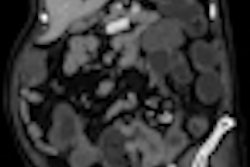 2011 03 02 14 07 58 446 2011 03 04 Cancer Sigmoid Thumb