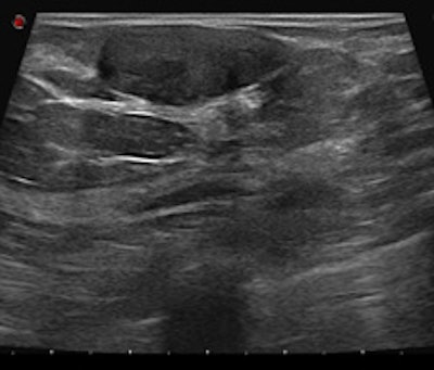 2011 03 02 22 58 32 353 2011 03 04 Bi Rads3b