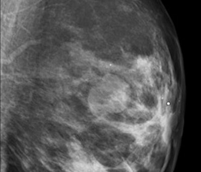 2011 03 02 22 58 33 531 2011 03 04 Bi Rads3a