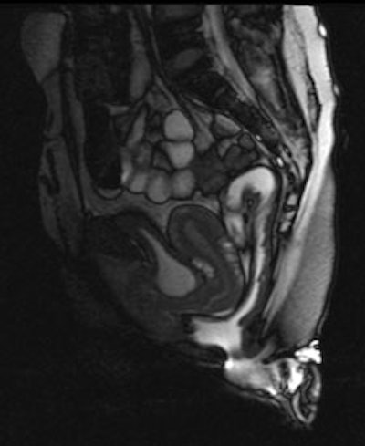 Sagittal late evacuation view shows a cystocele in the middle and posterior pelvic floor compartment. Image courtesy of Dr. Steve Halligan.
