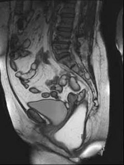 Left: MR image obtained at rest, after rectal filling with gel; normal values of anorectal angle and anorectal junction, with respect to the pubococcygeal line. Right: MR image obtained during straining and evacuation: A large anterior rectocele develops, associated with descent of the posterior pelvic floor. Images courtesy of Dr. Francesca Maccioni.