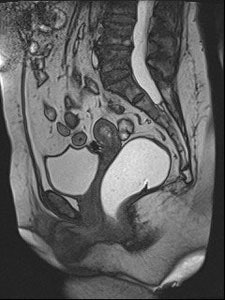 2011 03 02 23 45 44 913 2011 03 04 Pelvic Rectocele Rest