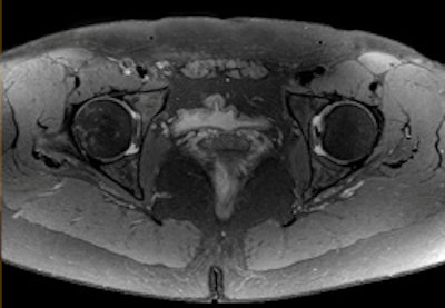 High-resolution MR image of the hip with spectral attenuated inversion-recovery (SPAIR) fat suppression. Image courtesy of Philips.