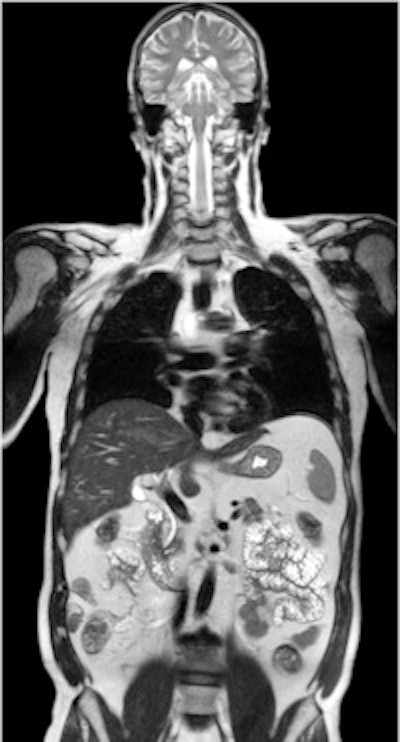 Two-station torso imaging with multitransmit. Image courtesy of Philips.