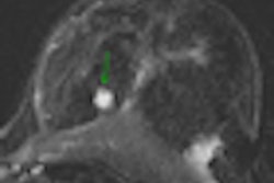 2011 03 04 14 55 52 662 2011 03 06 Advances Breast Thumb