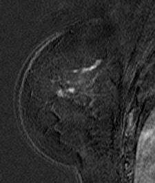 2011 03 04 14 55 53 310 2011 03 06 Advances Breast Right