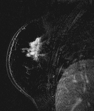 2011 03 04 14 55 53 348 2011 03 06 Advances Breast Left