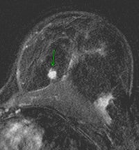 2011 03 04 14 55 54 972 2011 03 06 Advances Breast Fig 1