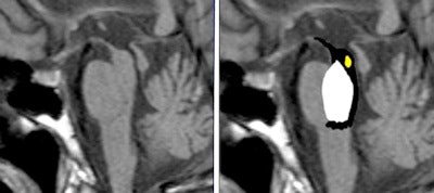 The 'penguin sign' may signal progressive supranuclear palsy. In this image, atrophy of the tectum, particularly the superior colliculus, can be seen. Image courtesy of Dr. Laughlin Dawes, Sir Charles Gairdner Hospital, Perth, Australia.