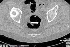 Example of a test case with two subtle rectal lesions in the rectum. Left: The small 7-mm polyp was detected by four out of five readers. Right: The 1-cm lesion with flat morphology was detected by all readers. This lesion was a flat cancer. Images courtesy of Dr. Philippe Lefere.