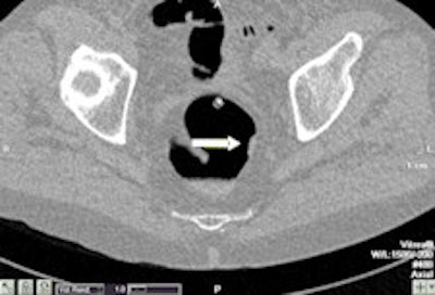 Example of a test case with two subtle rectal lesions in the rectum. Left: The small 7-mm polyp was detected by four out of five readers. Right: The 1-cm lesion with flat morphology was detected by all readers. This lesion was a flat cancer. Images courtesy of Dr. Philippe Lefere.