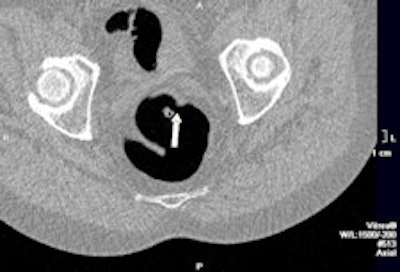 2011 03 24 14 23 26 57 2011 03 24 Ctc 7mm